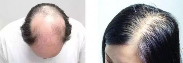 你的脱发都是有迹可循的