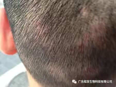 白发一族 | 顽固的头部难题——毛囊炎