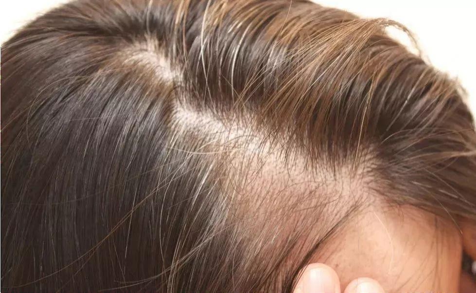 女性掉发增多应该怎么办？